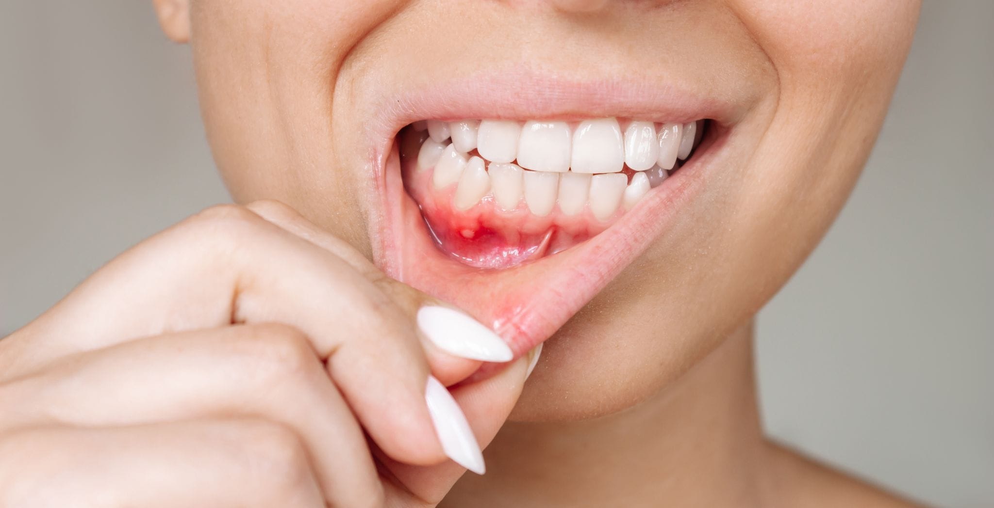 Receding gums treatment