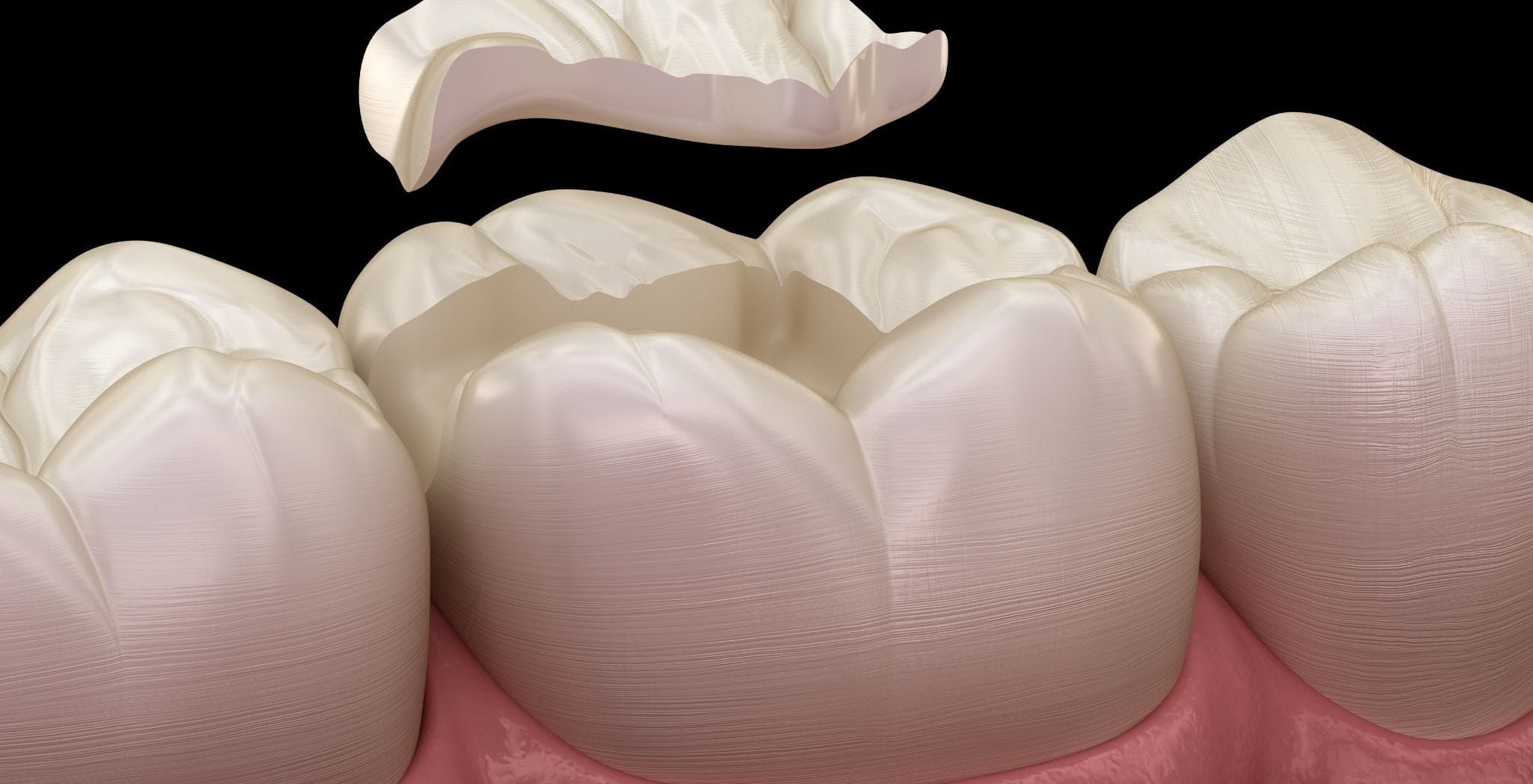 Dental inlays and onlays, Tooth restoration with inlays, Onlay dental treatment, Difference between inlays and onlays, Benefits of dental inlays, Dental onlays for tooth repair, Inlays and onlays procedure, Cosmetic dental restorations,
