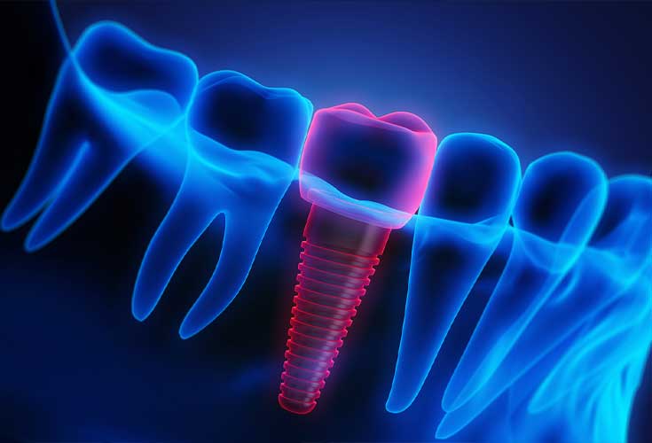 Dental implants for permanent tooth replacement in Forest Hill